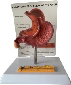 Model stomac - stadiile ulcerului gastric