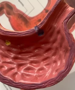 Alternative view of Model stomac - stadiile ulcerului gastric