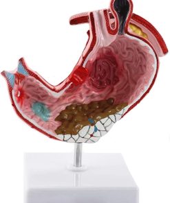 Model ulcer gastric